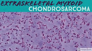 Extraskeletal Myxoid Chondrosarcoma 5Minute Pathology Pearls [upl. by Chaker458]