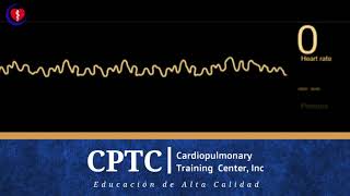 Fibrilación Ventricular [upl. by Spear]