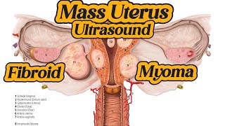 Uterus  Fibroid  Myoma  Mass On Ultrasound [upl. by Hermes]