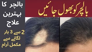 Baalchar Ka Elaj  Alopecia Areata Symptoms amp Treatment Urdu  saima tutorials [upl. by Race957]