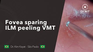 Fovea sparing ILM peeling  Vitreomacular traction [upl. by Proudlove]