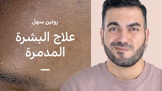 روتين لعلاج التهاب وتهيج البشرة 🥵 تصليح حاجز البشرة للرطوبة [upl. by Grover302]