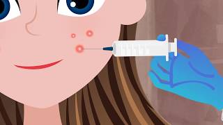 Cortisone Injection for a Big Pimple [upl. by Klement]