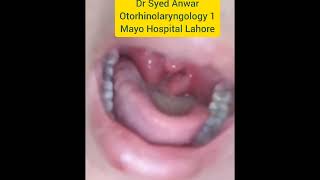 kissing tonsils  Enlarged tonsils  Parenchymatous tonsils  Tonsillectomy Brodski Classification [upl. by Alohcin]