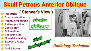 Skull Petrous Anterior Oblique View Stenvers view  स्टेनवर्स View in Hindi Skull radiography [upl. by Annaeerb]