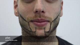 Beard Transplant Beard to Beard Transplant Hairline Clinic [upl. by Haliled182]