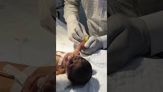 Newborn baby being cannulated youtubeshorts nursing sumitnicunursingstm newbornbaby cannula [upl. by Nelag]