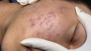 ACNE TREATMENT VU QUYNH MI Acne On Boys Cheek 2024 [upl. by Asserak]