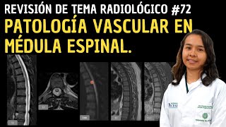 Revisión de tema 72 Patología vascular en médula espinal [upl. by Irrehs]