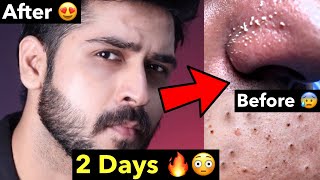 Remove Blackheads Whiteheads Naturally From Face  How to Remove Whiteheads Blackheads at Home [upl. by Yecad]