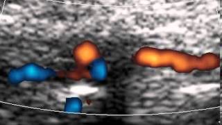 VERTEBRAL ARTERY DISSECTION [upl. by Nrojb829]