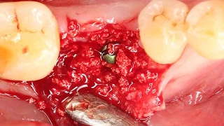 Clinical application of OSTEON™ lll Dentium alloplastic graft [upl. by Aniahs306]