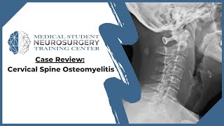 Case Review Cervical Spine Osteomyelitis [upl. by Lillie]