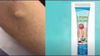 do lipoma removal creams work [upl. by Kenta]