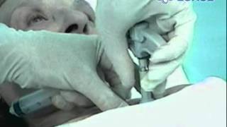 LEXELMEDICAL  ASPIRACION DE MEDULA OSEA [upl. by Terena]