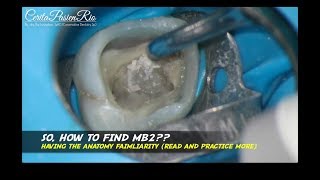 finding the MB2 canal in maxillary molar ultrasonic tip ET18D satelec endodontic treatment [upl. by Prichard]