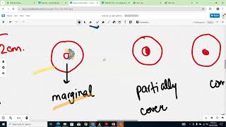 ANTEPARTUM HAEMORRHAGE DISCUSSION [upl. by Aihtak]