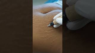 Stretch Marks Inkless Removal Boleyn Treatment Los Angeles 🌍 shorts [upl. by Anhaj495]