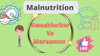 Kwashiorkor vs Marasmus DefinationDifference Malnutrition Nursing notes [upl. by Abba]