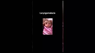 Laryngomalacia [upl. by Arodnahs17]