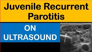 Juvenile Recurrent Parotitis On Ultrasound [upl. by Ielak226]