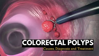 Colorectal Polyps Causes Signs and Symptoms Diagnosis and Treatment [upl. by Parish]