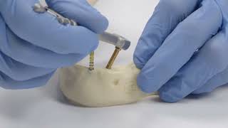 How to  Hands on using Angled Mini Conical Abutments [upl. by Myranda142]