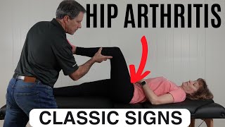 Classic Signs of Hip Arthritis [upl. by Adnawot491]