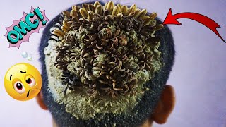 OMG Lots of Tiny Worms On Dandruff Removal 1151 [upl. by Schroth]