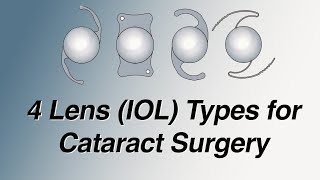 4 Main Lens IOL Types for Cataract Surgery Pros and Cons Basic Version [upl. by Adirahs]