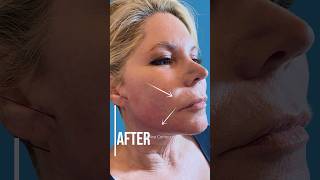 PDO Thread Lift Before and After PCH MedSpa Newport Beach [upl. by Nairam]