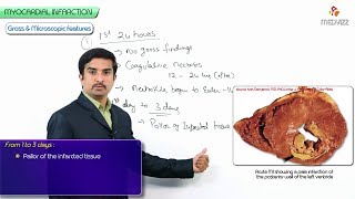 Pathology of Acute Myocardial Infarction  Gross and Microscopic features [upl. by Ameg]