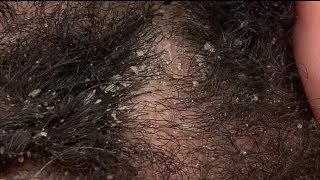 Dandruff Picking and Scratching  Flaky Eczema Scalp extreme close up ASMR [upl. by Langston]