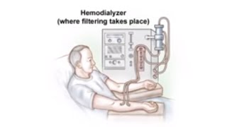 Dialysis Access and Fistula Procedure [upl. by Merce29]