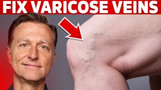 How to Treat Varicose Veins Naturally – Dr Berg [upl. by Nnarual]