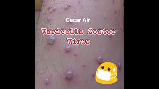 Varicella Zoster Virus atau Cacar Air [upl. by Uile57]