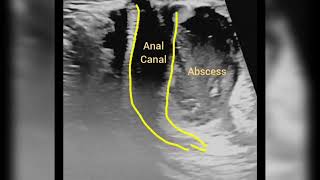 perianal abscess [upl. by Agem]