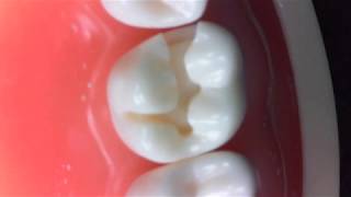 CLASS II AMALGAM PREP REFINEMENT 14 MOL [upl. by Nat]