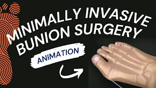 Minimally Invasive Bunion Surgery A Short Animation [upl. by Folberth]