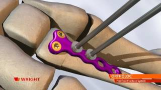 ORTHOLOC™ Forefoot Fracture System Animation [upl. by Claybourne]