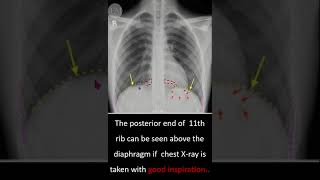 How to Identify the Posterior End of Ribs in Chest XRays [upl. by Malley]