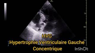 HVG Hypertrophie Ventriculaire Gauche Concentrique Échographie [upl. by Llerraf]