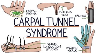 Understanding Carpal Tunnel Syndrome [upl. by Smiley]