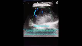 Warthin Tumor Parotid Gland Ultrasound [upl. by Enyrehtak]