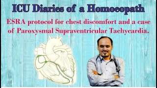 ESRA protocol for chest discomfort  Case of Paroxysmal Supraventricular Tachycardia [upl. by Undine]