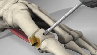 First Metatarsal Distal Chevron Osteotomy with Arthrex® LPS Screw [upl. by Phi]