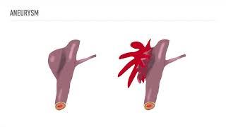 Aneurysms for EMTs [upl. by Zetram]