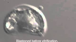 INSTITUT MARQUÈS  Frozen embryos vitrified blastocyst [upl. by Rem]