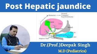 Post Hepatic jaundice  Obstructive jaundice  Deepak PD Singh [upl. by Haland801]