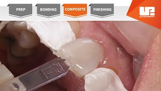 Composite  Your Complete Restorative Solution [upl. by Maddeu763]